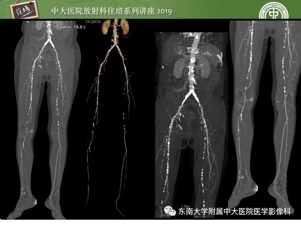 【PPT】下肢CTA的检查流程及评价
