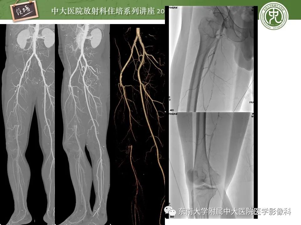 【PPT】下肢CTA的检查流程及评价