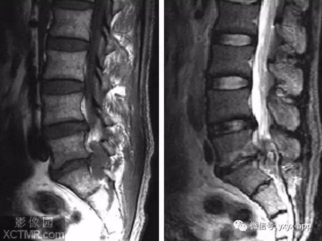 【病例】腰椎间盘突出1例MRI影像诊断分析