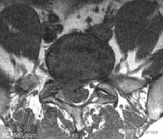 【病例】腰椎间盘突出1例MRI影像诊断分析