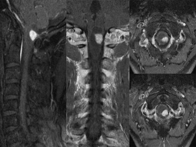 血管母细胞瘤 MRI 表现 血管母细胞瘤 MRI 表现