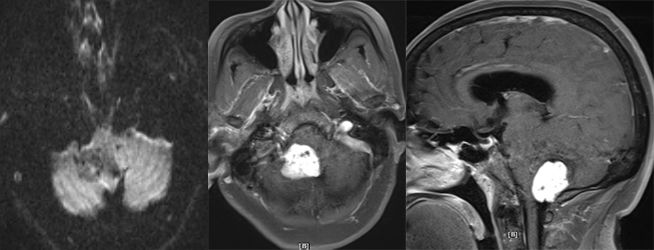 血管母细胞瘤 MRI 表现