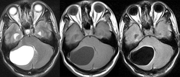 血管母细胞瘤 MRI 表现