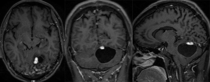 血管母细胞瘤 MRI 表现 血管母细胞瘤 MRI 表现