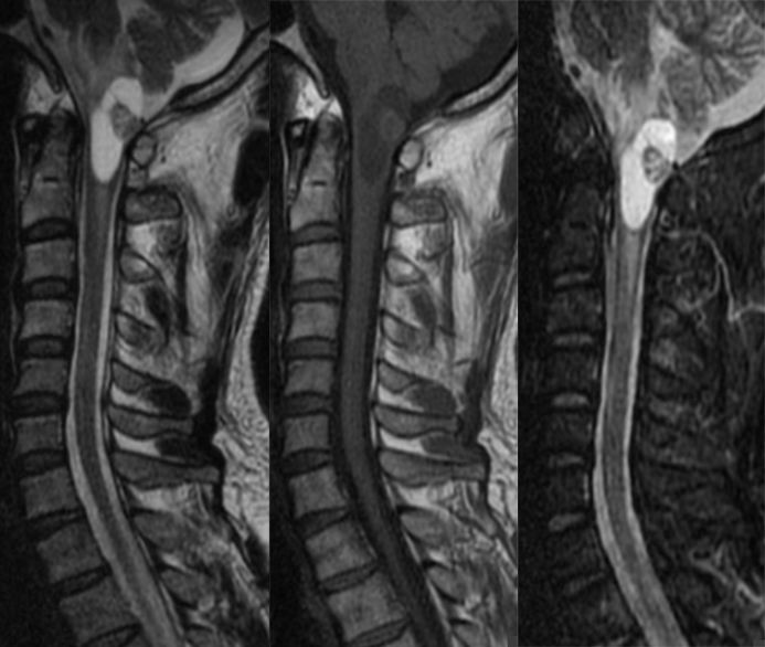 血管母细胞瘤 MRI 表现