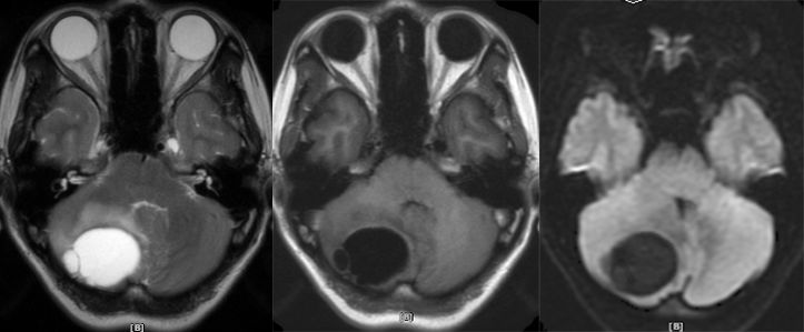 血管母细胞瘤 MRI 表现