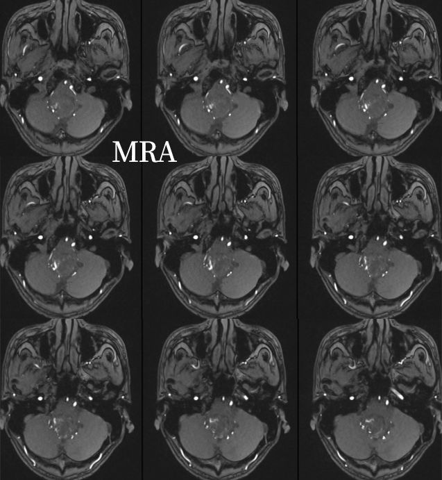 血管母细胞瘤 MRI 表现 血管母细胞瘤 MRI 表现
