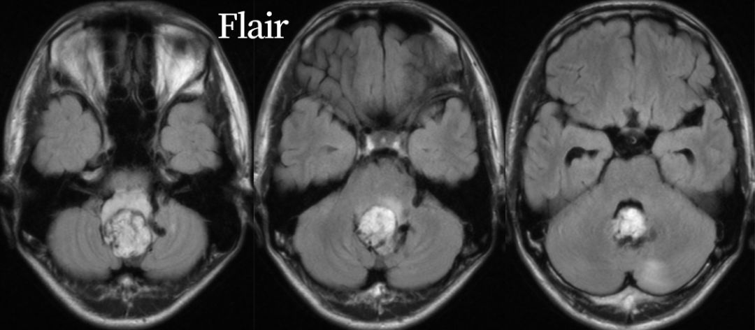 血管母细胞瘤 MRI 表现