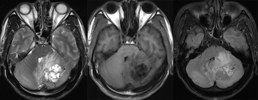血管母细胞瘤 MRI 表现
