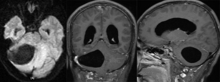 血管母细胞瘤 MRI 表现