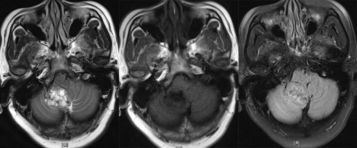 血管母细胞瘤 MRI 表现