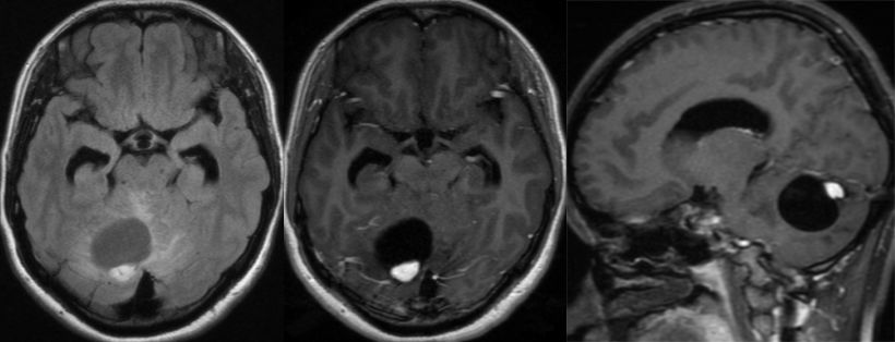 血管母细胞瘤 MRI 表现 血管母细胞瘤 MRI 表现