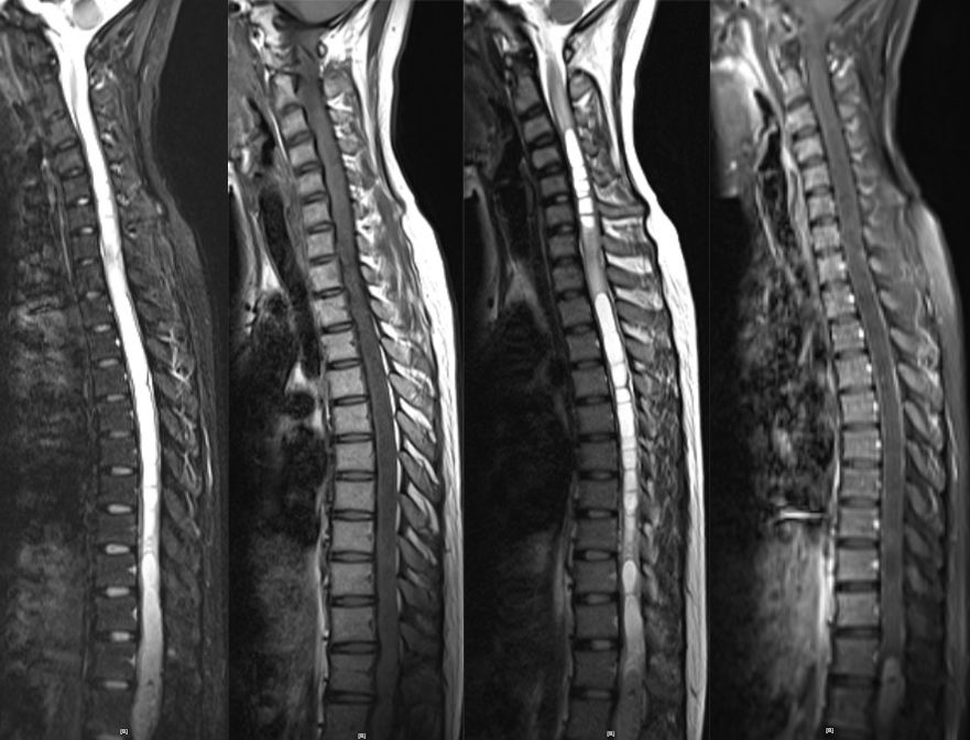 血管母细胞瘤 MRI 表现