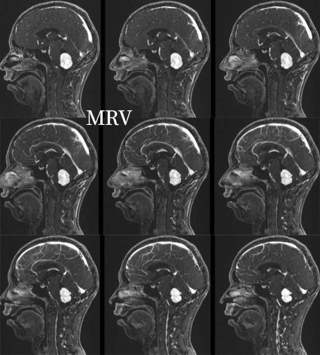 血管母细胞瘤 MRI 表现 血管母细胞瘤 MRI 表现