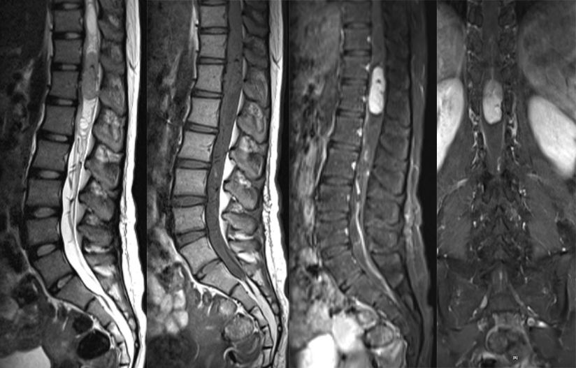 血管母细胞瘤 MRI 表现