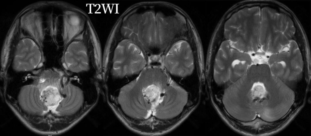 血管母细胞瘤 MRI 表现
