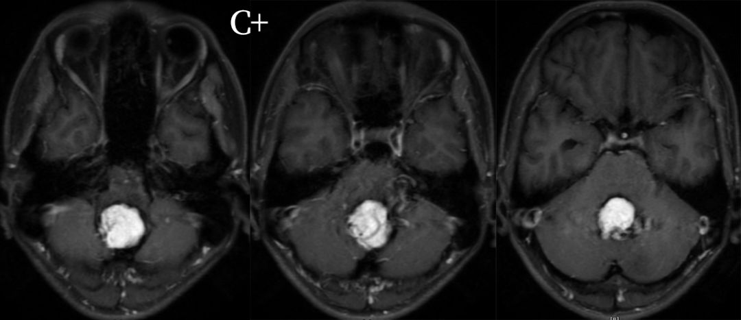血管母细胞瘤 MRI 表现 血管母细胞瘤 MRI 表现