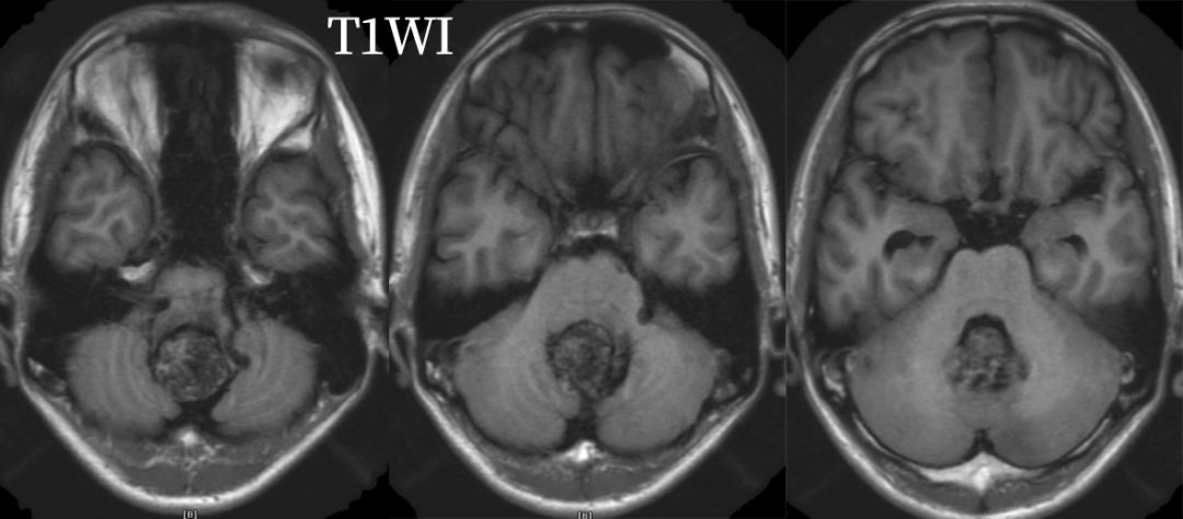 血管母细胞瘤 MRI 表现