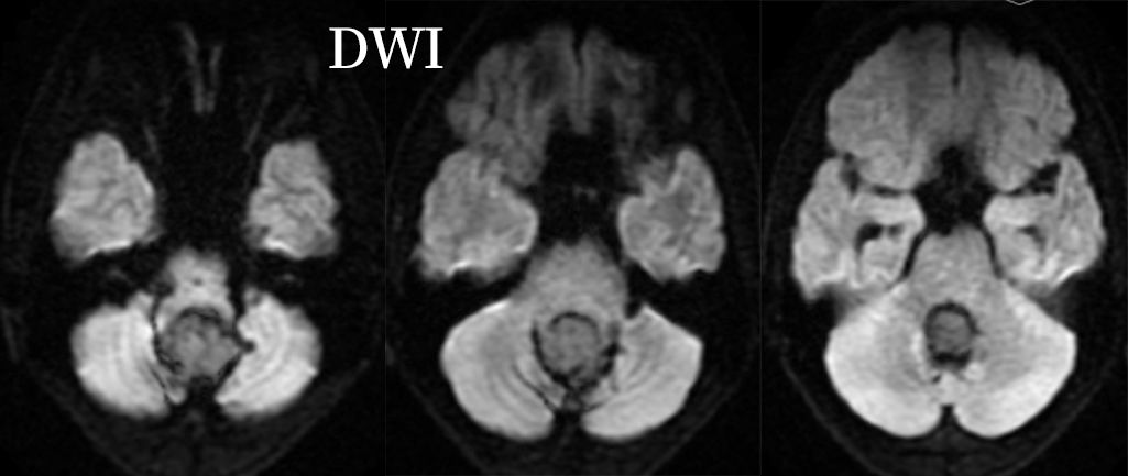 血管母细胞瘤 MRI 表现