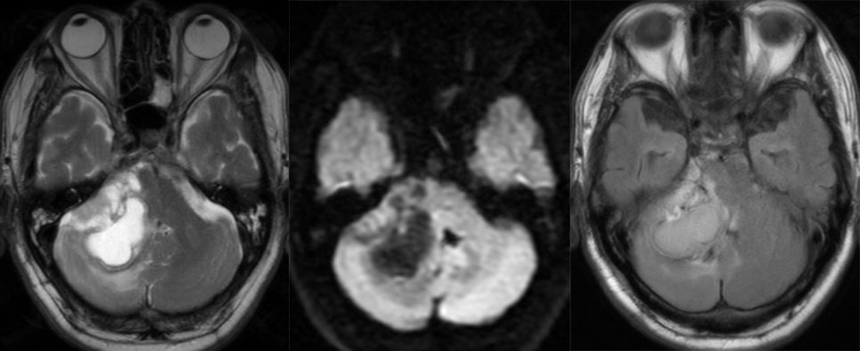 血管母细胞瘤 MRI 表现