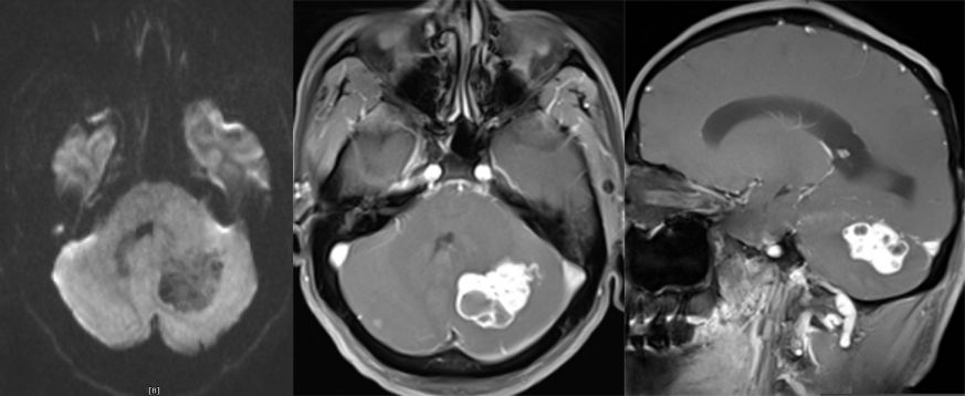 血管母细胞瘤 MRI 表现 血管母细胞瘤 MRI 表现