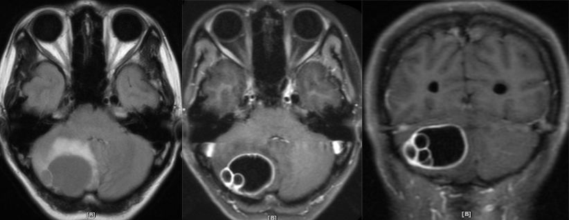 血管母细胞瘤 MRI 表现 血管母细胞瘤 MRI 表现