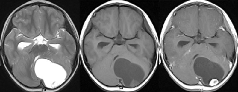血管母细胞瘤 MRI 表现