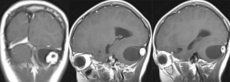 血管母细胞瘤 MRI 表现