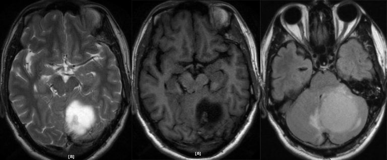 血管母细胞瘤 MRI 表现