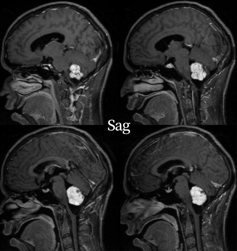 血管母细胞瘤 MRI 表现 血管母细胞瘤 MRI 表现