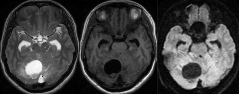 血管母细胞瘤 MRI 表现