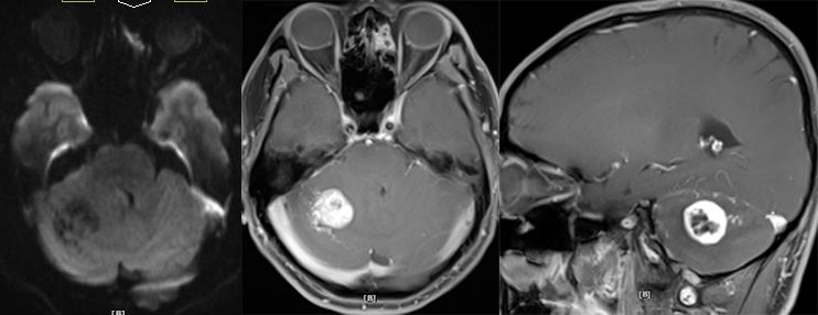 血管母细胞瘤 MRI 表现