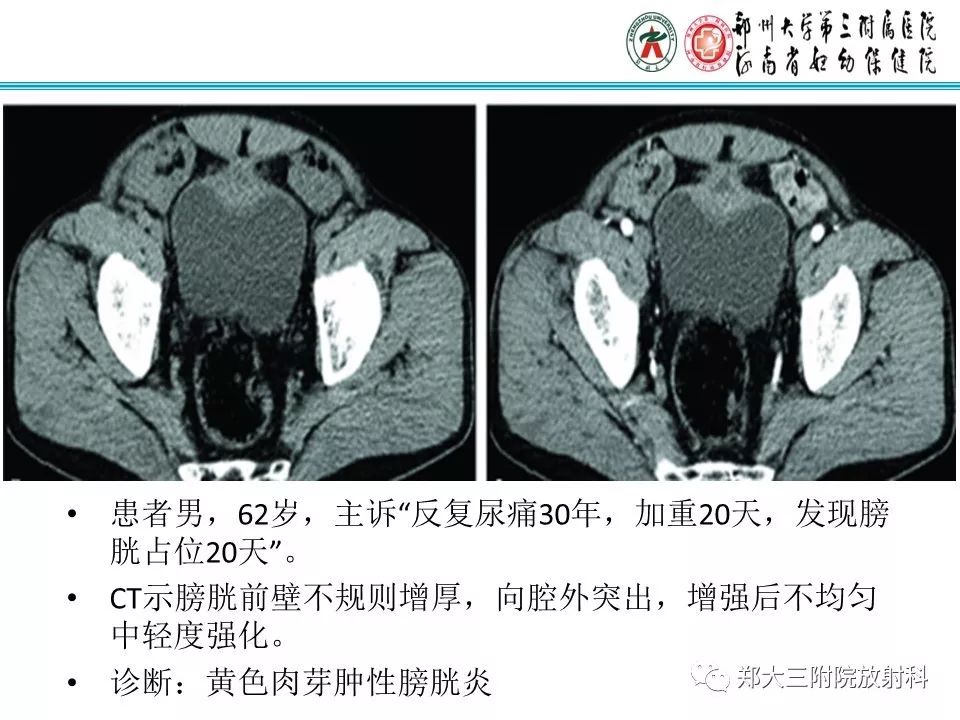 【病例】盆腔黄色肉芽肿性炎症1例MR影像