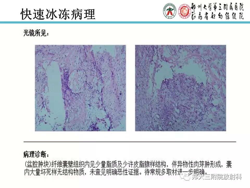 【病例】盆腔黄色肉芽肿性炎症1例MR影像