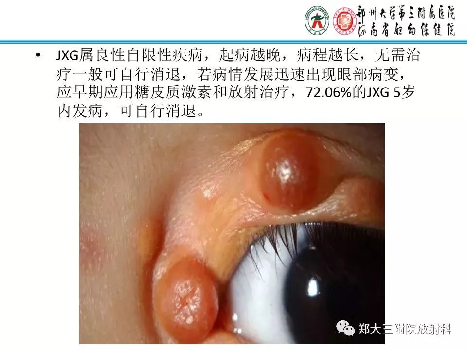 【病例】盆腔黄色肉芽肿性炎症1例MR影像