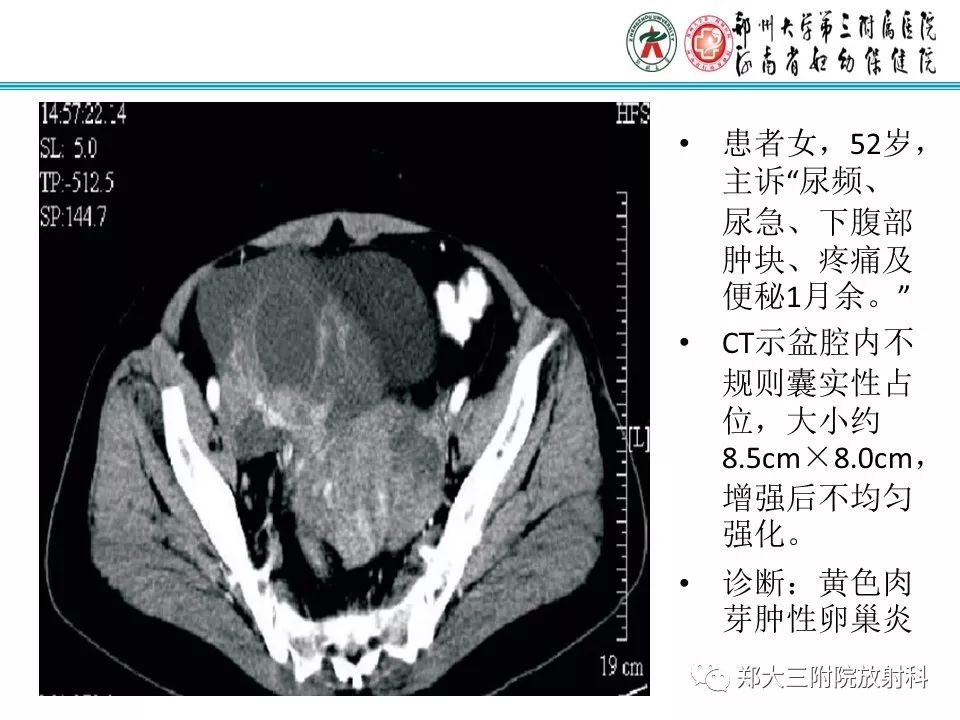 【病例】盆腔黄色肉芽肿性炎症1例MR影像