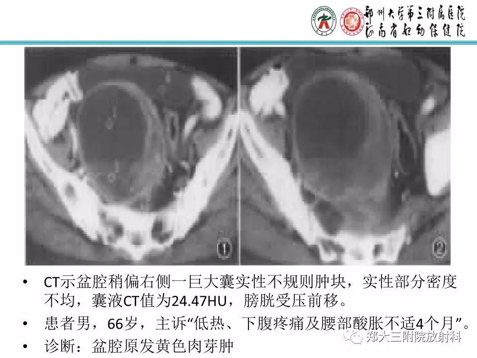 【病例】盆腔黄色肉芽肿性炎症1例MR影像
