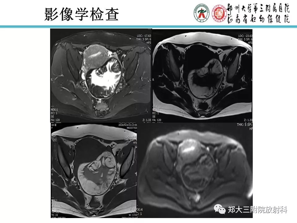 【病例】盆腔黄色肉芽肿性炎症1例MR影像