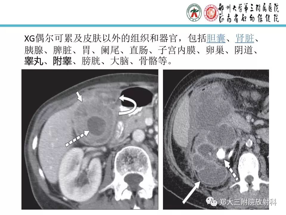 【病例】盆腔黄色肉芽肿性炎症1例MR影像
