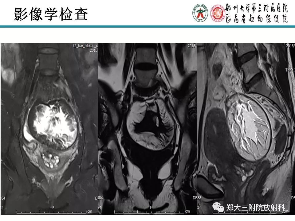 【病例】盆腔黄色肉芽肿性炎症1例MR影像