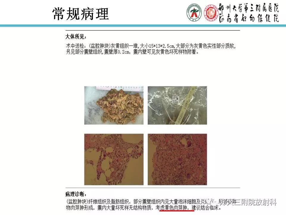 【病例】盆腔黄色肉芽肿性炎症1例MR影像