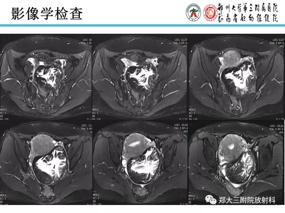 【病例】盆腔黄色肉芽肿性炎症1例MR影像