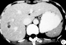 【病例】肝右叶炎性假瘤1例CT影像表现 【病例】肝右叶炎性假瘤1例CT影像表现