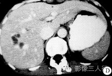 【病例】肝右叶炎性假瘤1例CT影像表现 【病例】肝右叶炎性假瘤1例CT影像表现