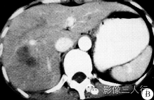 【病例】肝右叶炎性假瘤1例CT影像表现