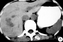 【病例】肝右叶炎性假瘤1例CT影像表现
