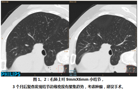 【病例学习】病理证实为原位的肺GGO一例 【病例学习】病理证实为原位的肺GGO一例