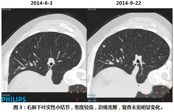 【病例学习】病理证实为原位的肺GGO一例 【病例学习】病理证实为原位的肺GGO一例