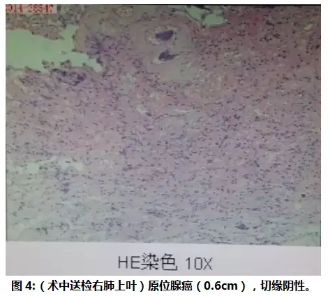 【病例学习】病理证实为原位的肺GGO一例