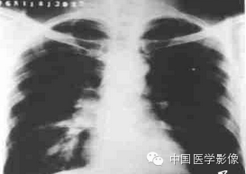 【病例学习】左肺上叶类癌一例CT影像表现